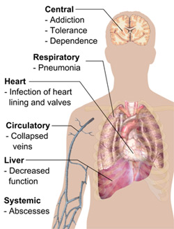 Effects of Heroin